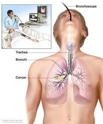 Bronchoscope