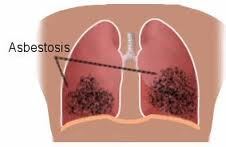 Asbestosis